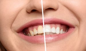 teeth whitening dapto