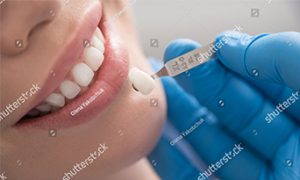 teeth whitening dapto