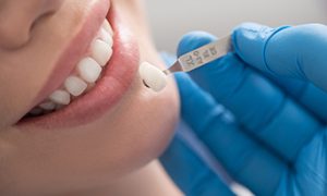teeth whitening dapto