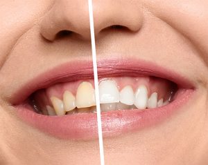 teeth whitening dapto