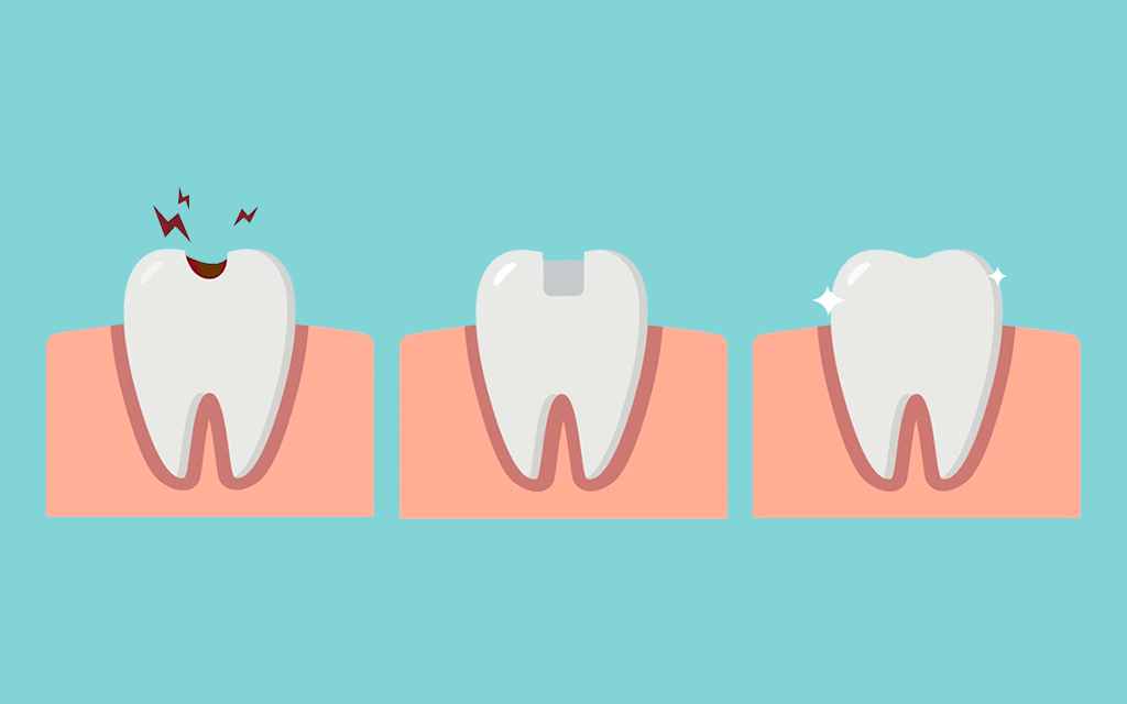 Dental Filling