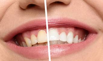 Teeth whitenig