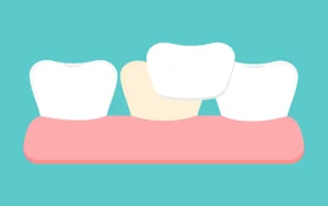 Crowns and Veneers Last Longer