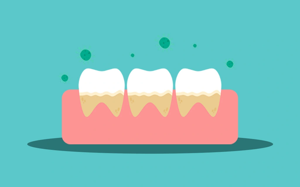 plaque bacteria bad teath