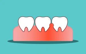 Gum inflammation