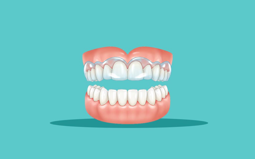 Custom Sports mouthguard 