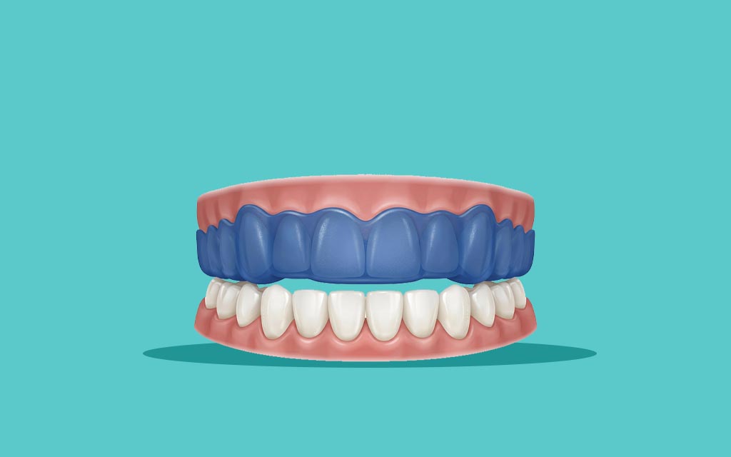 Sports mouthguard protection 