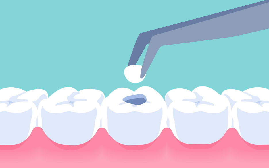  Dental filling treatment 