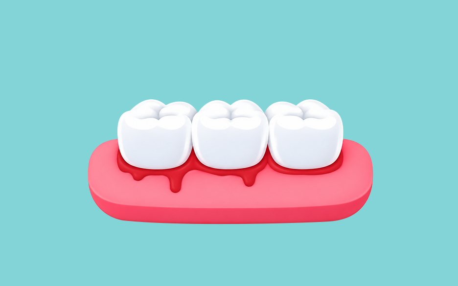 Early Gum Disease 
