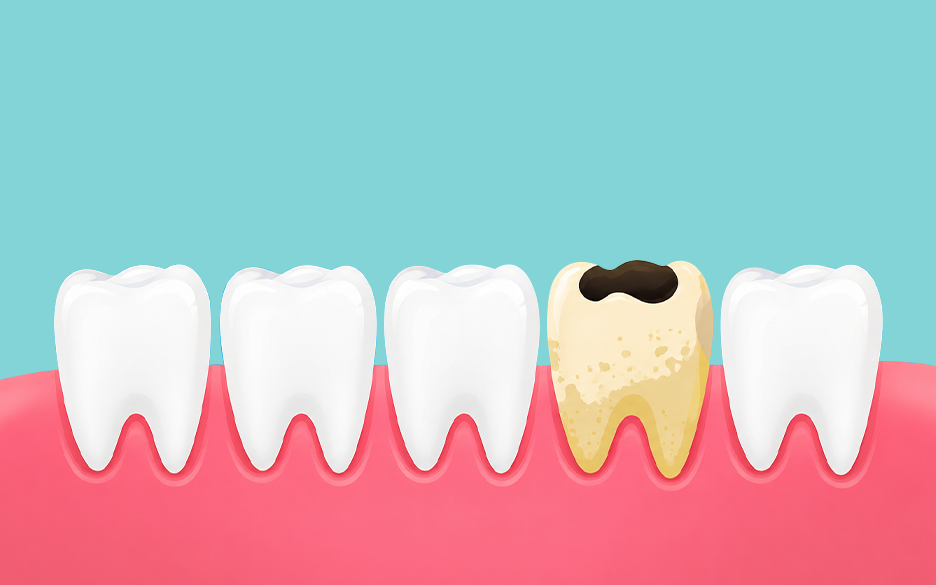 Tooth Decay Signs 