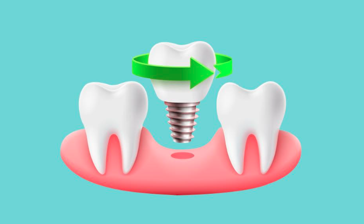 Dental Implant Placement 