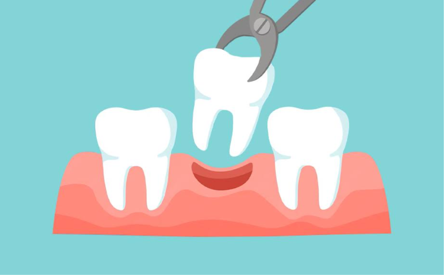 Tooth Extraction Procedure