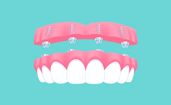  Implant Supported Denture 