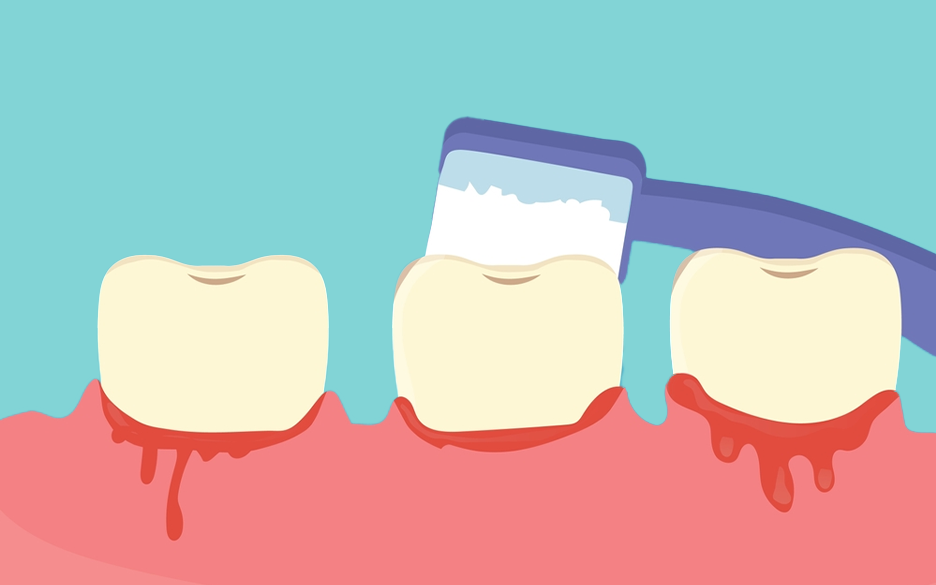 Bisphosphonates dental care 